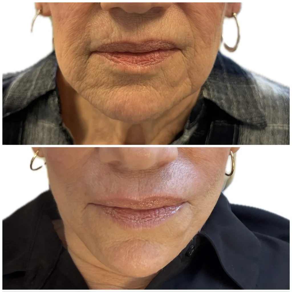 SkinVive before and after, front view of the skin on a woman's lower face and chin, shown top and bottom
