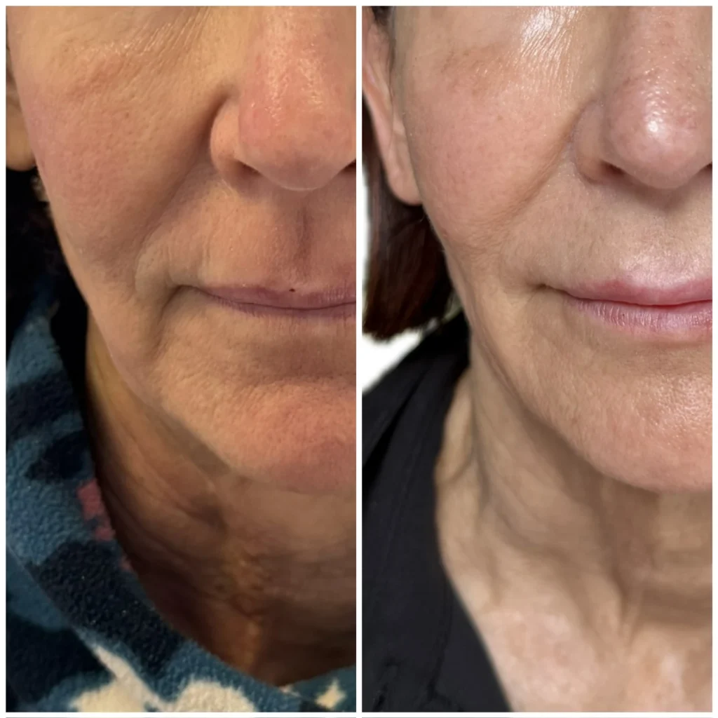 SkinVive before and after, close-up of the skin on a woman's cheek, jaw, and neck, shown side by side